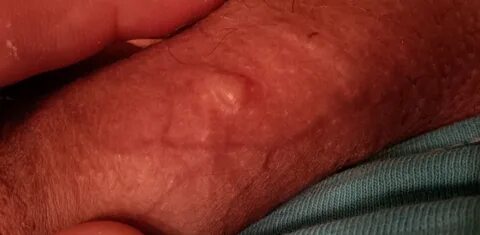 Lump under the skin on penis - primeunit.eu