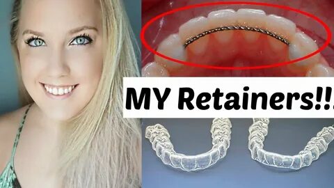 Retainers After Braces Permanent and Temporary Ashley Craig 