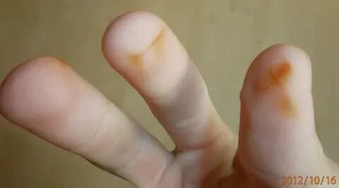 Hellbraune Flecken an den Fingern (Haut)