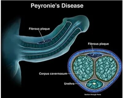 Normal Penis Curvature vs. Peyronie’s Disease - Peyronie's D