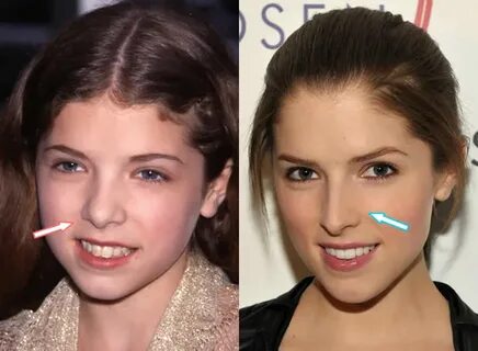 Did Anna Kendrick Get Surgery To Look HOT?