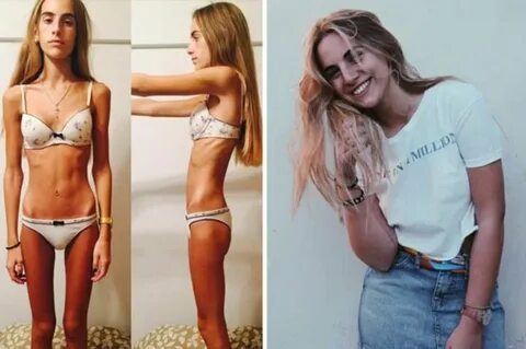 Teenager who weighed 5.5st during anorexia battle shares her