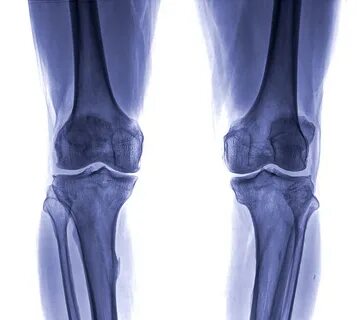 X-ray + Assessment for Knee Arthritis Pain @ $100