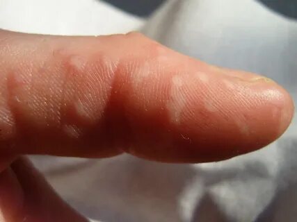 Гнойнички на пальце в течении 7 лет - Вопрос дерматологу - 0