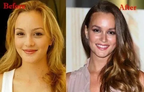 Leighton Meester Plastic Surgery Before and After