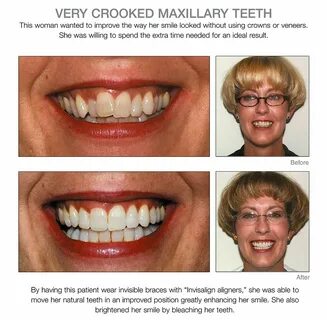 Crooked teeth Dentistry, Cosmetic dentistry, Cosmetic dentis
