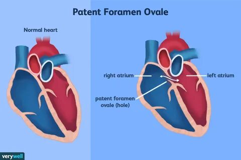 Migraines and Patent Foramen Ovale Kind