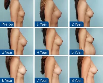 Breast Implants : 5 Most Common Questions