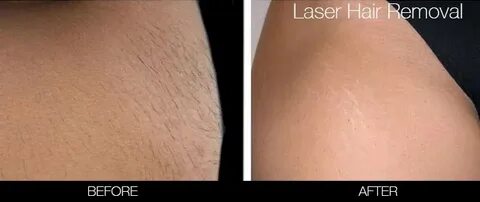 Brazilian Laser Hair Removal - Brazilian Vs Bikini Line