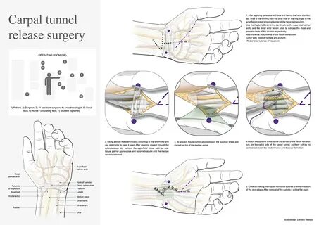 Carpal tunnel release surgery (CTR) on Behance