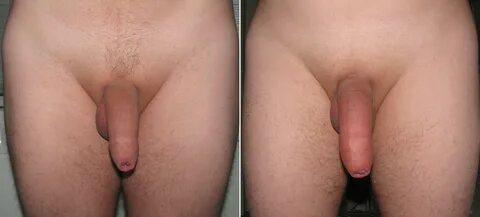 File:A flaccid penis after using a penis pump.JPG - Wikimedi