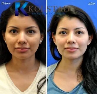 liquid rhinoplasty san diego 547 copy Dr. Kolstad - San Dieg