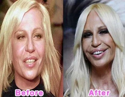 Celebrity Plastic Surgery Before and After Photos (16 pics) 