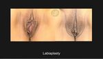 Vaginal - Feminine Rejuvenation Designer Vagina Before & Aft