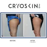 CryoSkin Before and After Photos - Simply Kneaded