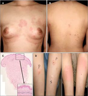 A, B) Pruritic erythematous patches with edema on the chest and back... Download