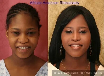 Patient #6319 Facial Cosmetic Surgery Before and After Photo