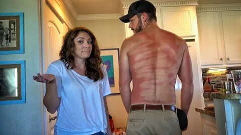 The Weirdest Sunburn Ever..... - YouTube