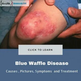 Blue Waffle Disease - Causes Pictures Symptoms And Treatment