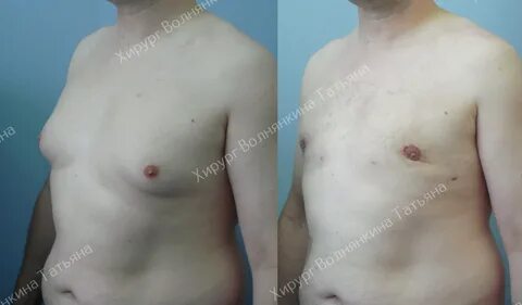 Лечение гинекомастии у мужчин в Москве