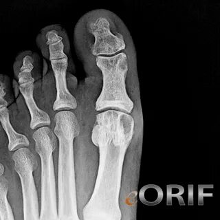 Gouty Arthritis Foot X-ray Related Keywords & Suggestions - 