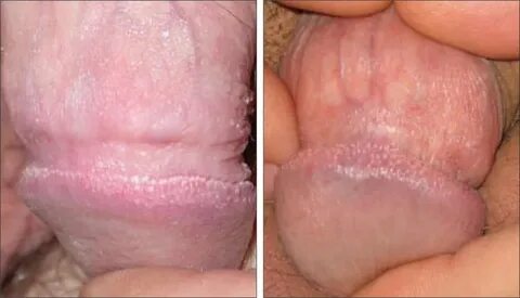 Multiple pearly penile papules on the coronal margin of the 