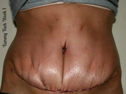 Tummy Tuck Results 1 Year Later Tummy Tuck Scar After A Year