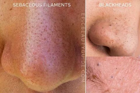 Blackheads Vs Sebaceous Filaments - Blackheads - Expert Skin