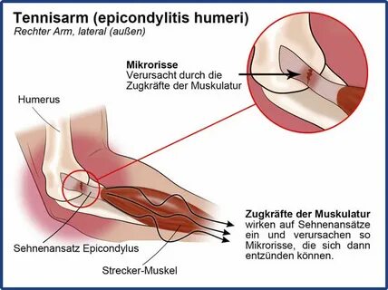 Epicondylitis Radialis / Tennis Elbow Lateral Epicondylitis 