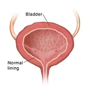 What is Interstitial Cystitis? Saint Luke's Health System