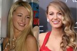 Celebrity plastic surgery: Before and after photos