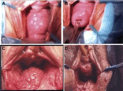 A) Stage 2 anterior compartment prolapse. (B) Cervix on trac