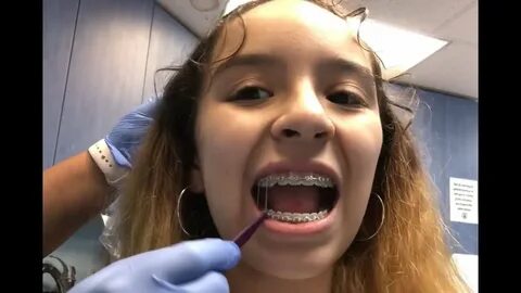 Fetish braces