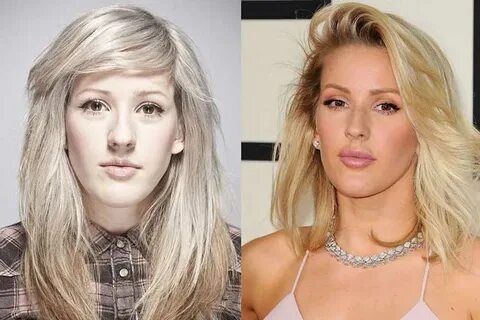 Did Ellie Goulding Get Plastic Surgery Including Lips and No
