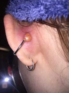 Understand and buy what to do if your conch piercing is infe