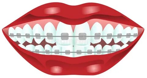 Процесс коррекции зубов с ортопедическими расчалками. Иллюст
