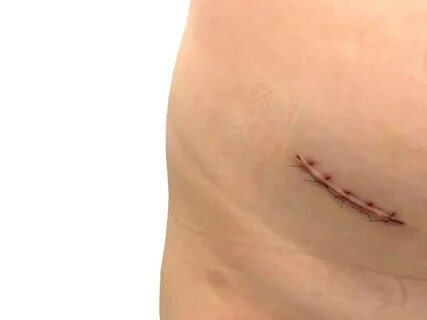 Appendicitis Scar - Сток картинки - iStock