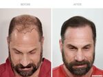 Hair Transplant Before and After Gallery New York HairCareMD