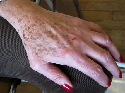 Коричневые пятна на коже лица, кистей, спины после 40-50 лет