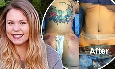Teen Mom 2 star Kailyn Lowry receives butt implant surgery i