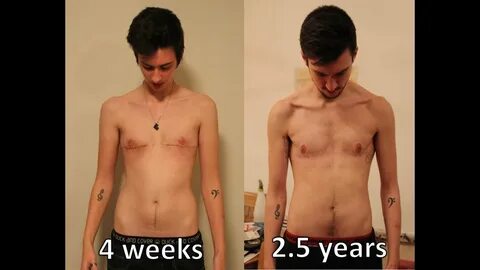 FTM Transgender: 2.5 years post op top surgery update and co