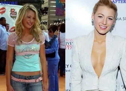 Blake Lively Archives - Page 3 of 3 - CELEB-SURGERY.COM