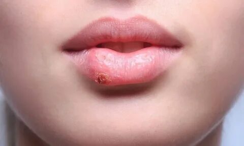 Bump on Lip: Check Out the Causes and Its Treatment