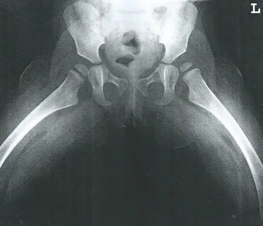 Gallery of x of hip dysplasia * Boicotpreventiu.org