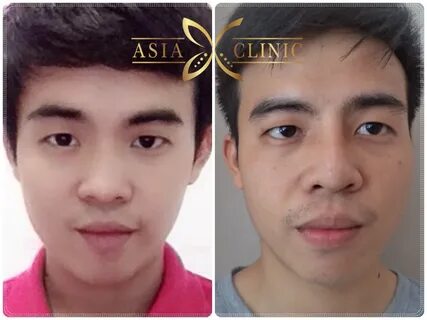 Asian Nose Job Before And After - Top Asian Countries Offeri