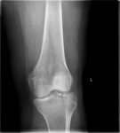 File:Lateral Tibial Plateau fracture XRay with Depression.jp