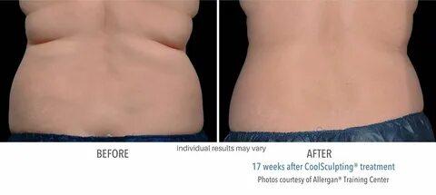 CoolSculpting Elite Before and After New Treatment and Bette