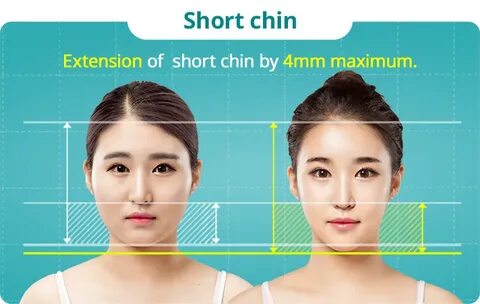 Make a small face with a V-line balance (ID Hospital)