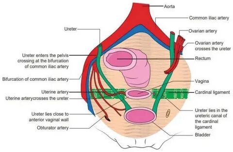 Ureteric Injury in Gynecology Surgery IntechOpen