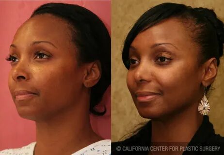 Patient #6309 African American Rhinoplasty Before and After 